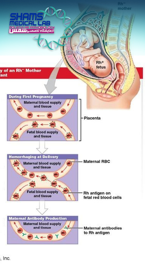 تشخیص زود هنگام ناسازگاری RH  و بیماری همولیتیک جنین و نوزاد 
